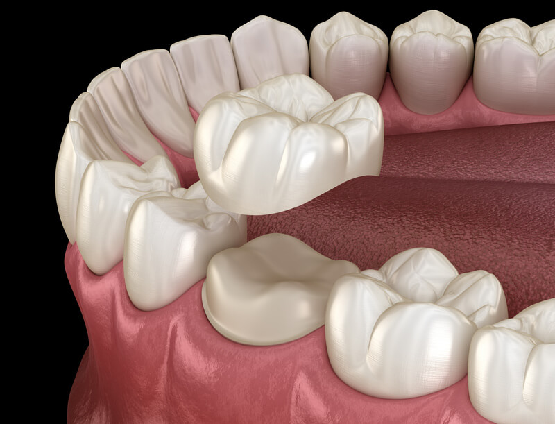 dental crown