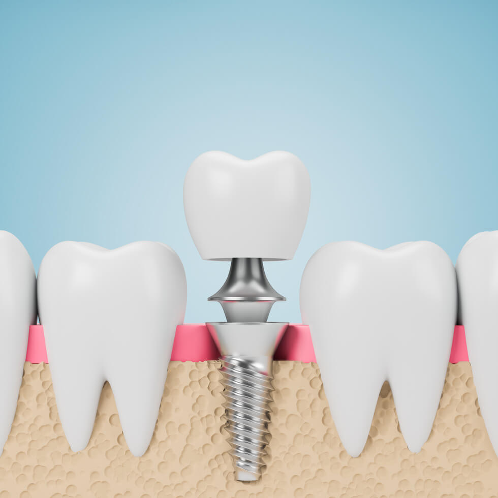 dental implants 1