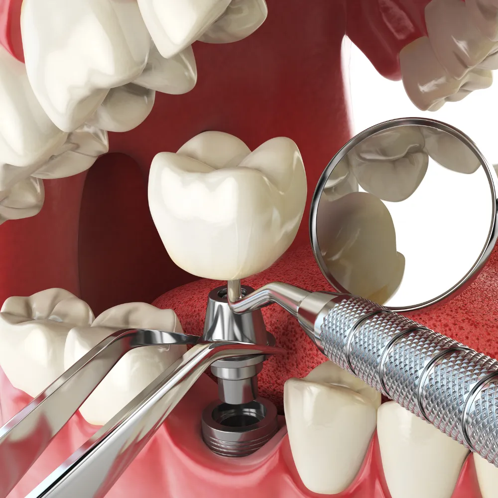 Dental Implants