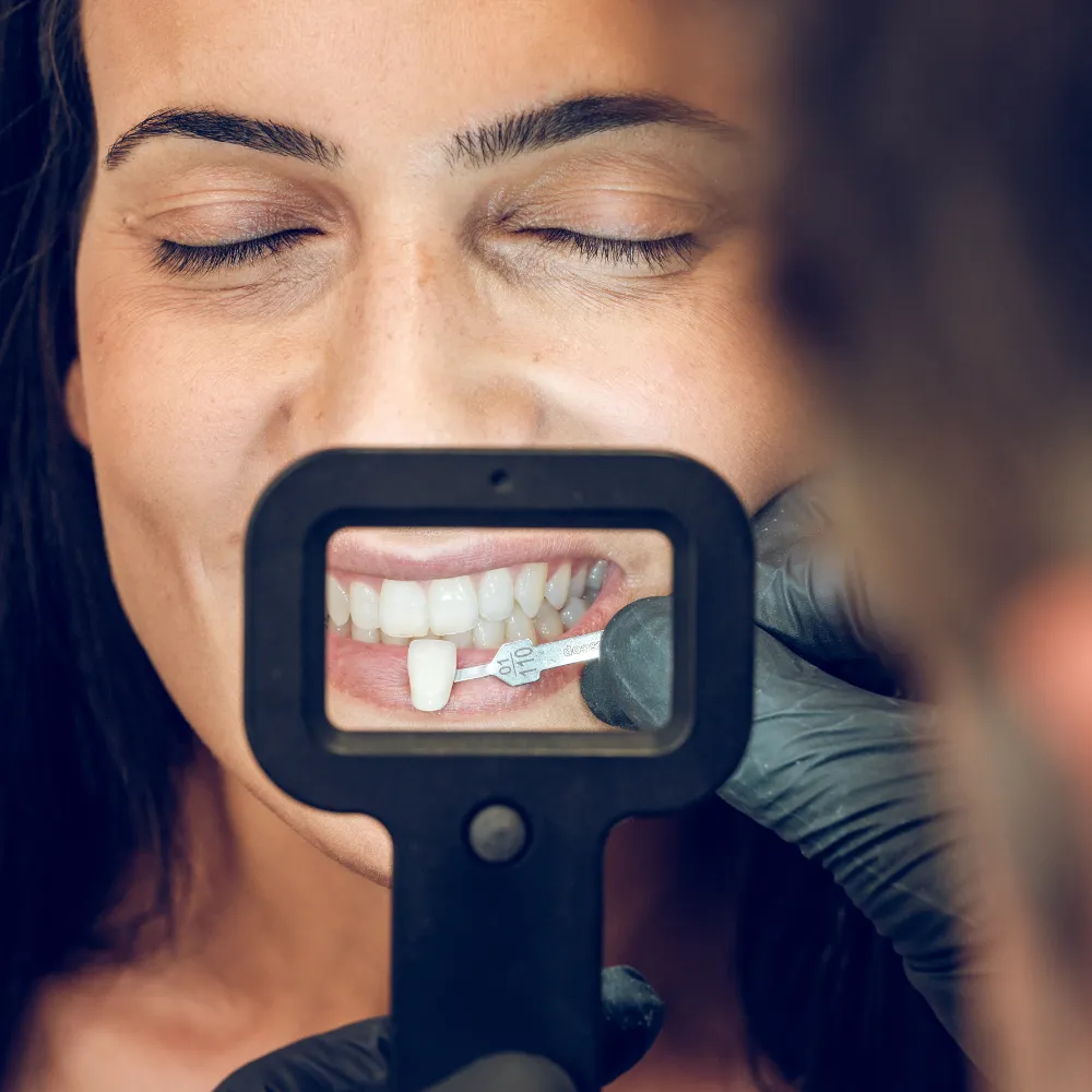 Veneers