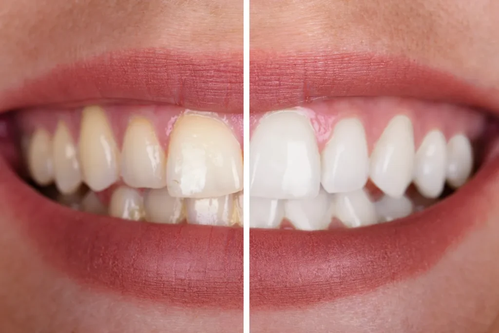 Polishing Your Teeth